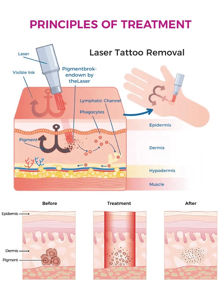 No scar tattoo removal laser machine No scar tattoo removal laser machine